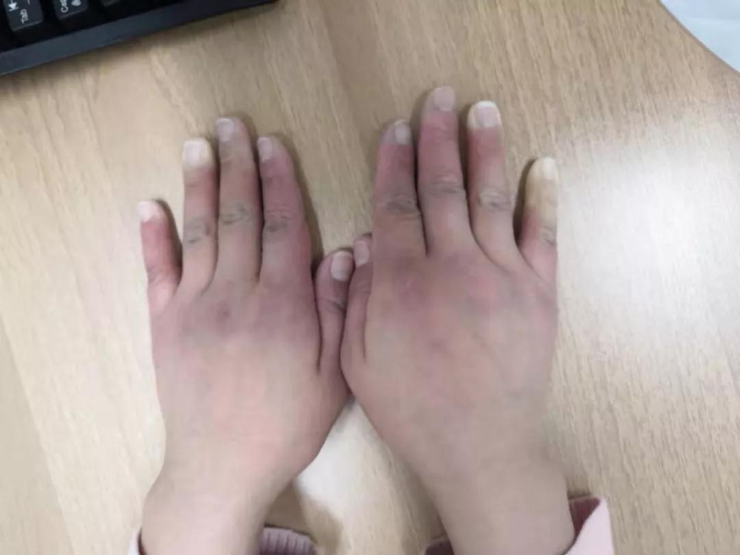 “手指、腳趾發(fā)白、發(fā)紫……”這些“小毛病”千萬別大意