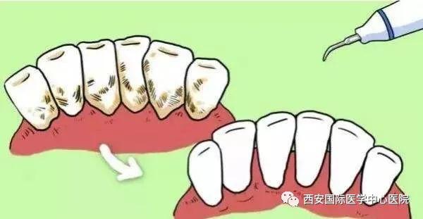 牙齒上的黃斑好難看，三招告訴你如何預防氟斑牙