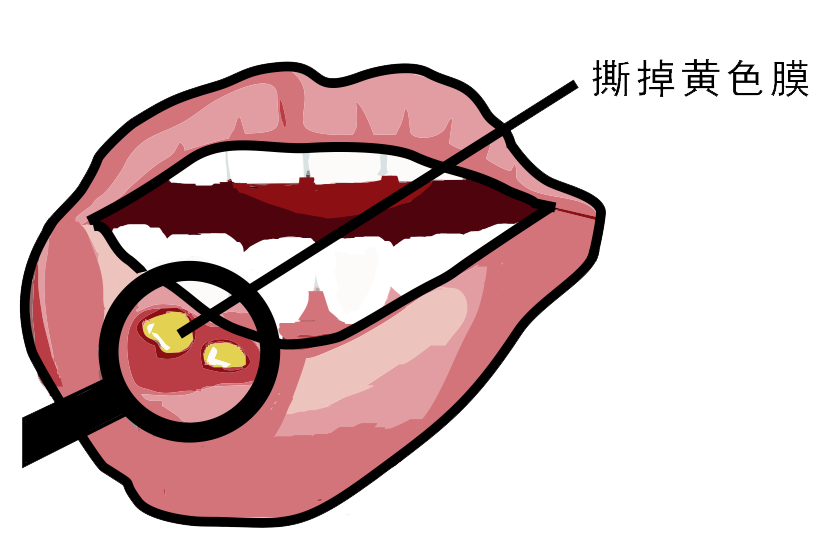 經(jīng)常口腔潰瘍，真的只是缺維生素嗎？