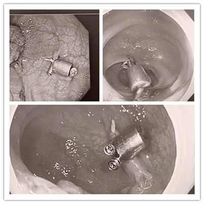 消化病醫(yī)院內(nèi)外科聯(lián)合開展3例“磁環(huán)預(yù)標(biāo)記輔助腹腔鏡結(jié)、直腸癌根治術(shù)”